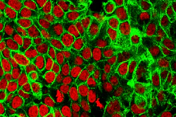 This microscope image made available by the National Cancer Institute Center for Cancer Research in 2015 shows human colon cancer cells with the nuclei stained red. Cancer is a disease of the genome, or full set of instructions for running cells, that occurs when changes in a person’s DNA cause cells to grow and divide uncontrollably.