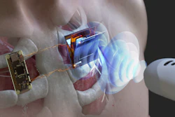 Schematic illustration of ​​wirelessly charging a body-implanted electronic device using an ultrasonic probe.