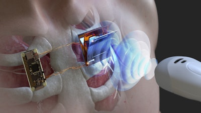 Schematic illustration of ​​wirelessly charging a body-implanted electronic device using an ultrasonic probe.