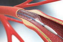 Medtronic Gets FDA Approval for Drug-Eluting Stent