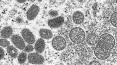 This 2003 electron microscope image made available by the Centers for Disease Control and Prevention shows mature, oval-shaped monkeypox virions, left, and spherical immature virions, right, obtained from a sample of human skin associated with the 2003 prairie dog outbreak. WHO's top monkeypox expert Dr. Rosamund Lewis said she doesn’t expect the hundreds of cases reported to date to turn into another pandemic, but acknowledged there are still many unknowns about the disease, including how exactly it’s spreading and whether the suspension of mass smallpox immunization decades ago may somehow be speeding its transmission.