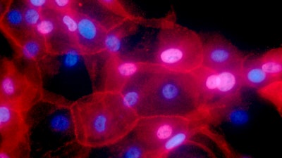This undated fluorescence-colored microscope image made available by the National Institutes of Health in September 2016 shows a culture of human breast cancer cells. A study discussed at the 2022 meeting of the American Society of Clinical Oncology suggests some low-risk breast cancer patients can omit radiation after lumpectomy.