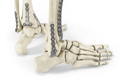Enovis, formerly branded as DJO, introduces the new Arsenal Ankle Plating System. 37 Plates within nine plate families address both tri-malleolar and intra-articular fracture patterns.