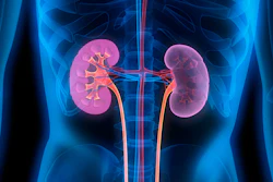 Renal denervation with TIVUS is a minimally invasive procedure.