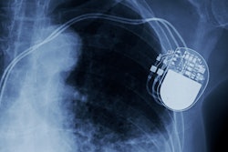 Abbott said the data reinforces the capabilities of its structural heart solutions