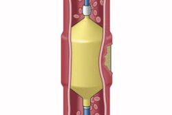 Solus Gold and Solus Flex Embolization Devices for peripheral vessel occlusion.