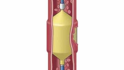 Solus Gold and Solus Flex Embolization Devices for peripheral vessel occlusion.