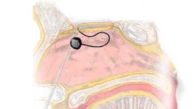 Leucadia Therapeutics Arethusta Tm Device