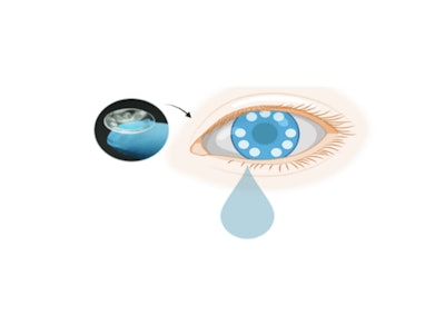 Scientists from the Terasaki Institute for Biomedical Innovation (TIBI) have developed a contact lens that can capture tears for the detection of exosomes, nanometer-sized vesicles found in bodily secretions which have the potential for being diagnostic cancer biomarkers.