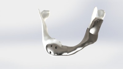 Netherlands Cancer Institute carried out first successful operation with custom 3D-printed titanium lower jaw.