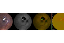 A color photograph of the ocular fundus, conventional black-and-white coded fundus autofluorescence, color-coded fundus autofluorescence, and primary emitted wavelength of fundus autofluorescence.