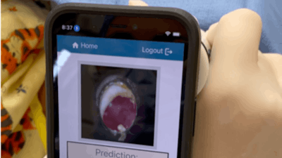 OtoDx is currently being employed in a prototype device paired with a smartphone app. The device acts as a “mini otoscope” that would fit over the phone’s camera and allow clinicians to take photos of the inside of a child’s ear, upload them directly to the app and receive a diagnostic reading in seconds.