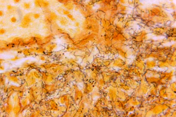 This 1966 microscope photo made available by the Centers for Disease Control and Prevention shows a tissue sample with the presence of numerous, corkscrew-shaped, darkly-stained, Treponema pallidum spirochetes, the bacterium responsible for causing syphilis.
