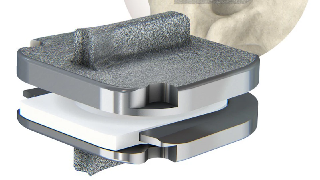 Appleton Centinel Centinel Spine Debuts Commercial Use of Cervical Total Disc Replacement ...