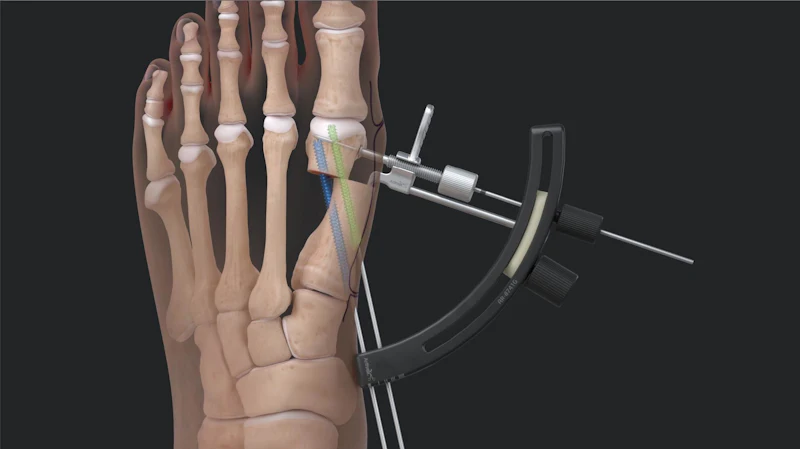 Sign Non Invasive Arthrex Launches Minimally Invasive Procedure for Bunion Correction ...