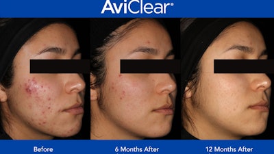Avi Clear 12 Month Results