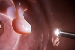 Targeted Hyperthermia Therapy Transfers Energy Via Infrared Light To Biocompatible Gold Nanorods In Colorectal Cancerous Tumors Which Will Then Convert The Light Energy Into Heat