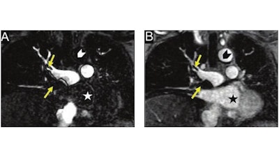 Patient was found to have deep vein thrombosis. Gadolinium-enhanced MRA was performed to assess for pulmonary embolus (PE). Coronal contrast-enhanced T1-weighted images in pulmonary arterial phase (A) and low flip-angle delayed phase (B) show PE (arrows, A and B). Delayed-phase image also shows cardiac chamber (star) and ascending thoracic aorta (chevron). Multiphase acquisition of MRA during inflow and outflow of contrast agent from pulmonary arteries is in distinction to single acquisition of CTA and may facilitate obtaining optimal enhancement of pulmonary arteries.