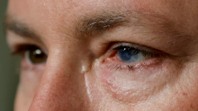 Phil Durst, who has undergone an experimental stem cell procedure with his eyes, sits for a portrait in Homewood, Ala., on Tuesday, Aug. 15, 2023.