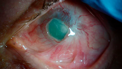 This photo provided by Mass Eye and Ear in August 2023 shows Phil Durst's injured eye before surgery in Boston.