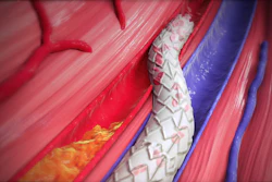 Vein Becoming Artery With Lim Flow Crossing Stent