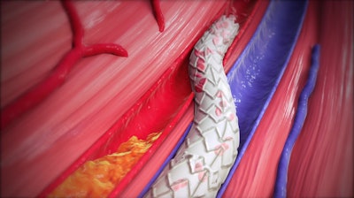 Vein Becoming Artery With Lim Flow Crossing Stent