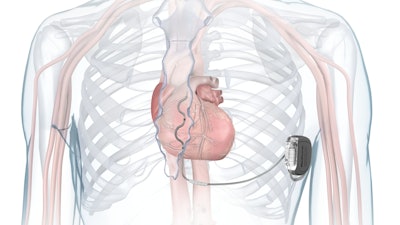 Mdt Aurora Ev Icd Illustration In Chest High Res