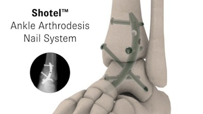 Shotel Medical Nail System Image Light