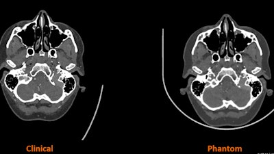 Siemens Ct Scan Comparisson