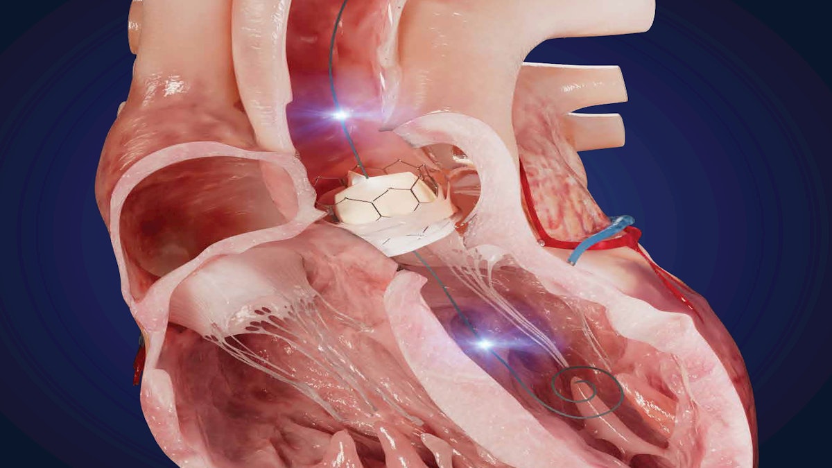 Xenter Debuts Dual Sensor Guidewire for Valve Replacement Surgery ...