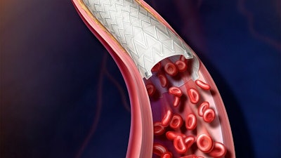 The investigational Vascular Covered Stent is a self-expanding, low profile, polytetrafluoroethylene encapsulated nitinol implant.