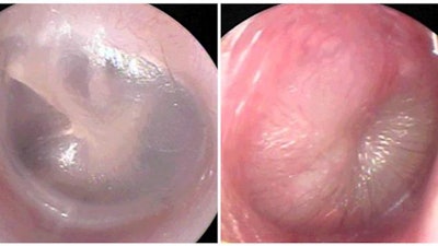 Images of eardrums from a healthy patient (left) or with acute otitis media (right) captured by the new smartphone app.