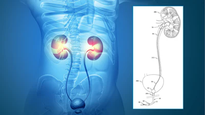 The above diagram shows how the catheter system would interact with the kidney. Balloons allow the catheter to stay in place while treatment is being delivered and the drug elution ports at the tip of the device allow for liquid drug to be delivered directly into the kidney. For patients who are likely to need further treatments, the systems can remain in the patient for days, weeks, or more.