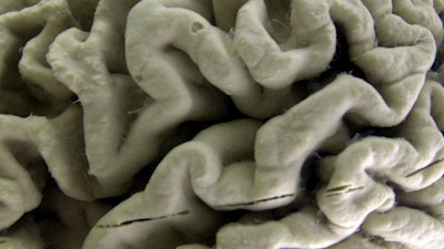 A section of a human brain with Alzheimer's disease is displayed at the Museum of Neuroanatomy at the University at Buffalo, in Buffalo, N.Y., Oct. 7, 2003. A long-feared gene appears to do more than raise people’s risk of Alzheimer’s: Inheriting two copies can cause the mind-robbing disease, according to research published in the journal Nature Medicine on Monday, May 6, 2024.