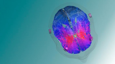 A model image of the targeted deep brain zone, the striatum, a key player in reward and reinforcement mechanisms.