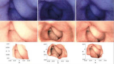 Three original images from an artificial colon, taken using an endoscope. The 3D model can be used to adjust the lighting in an original image so that darker areas become better illuminated, as shown in the images below. Bottom: The reconstructed 3D model based on the three originals.