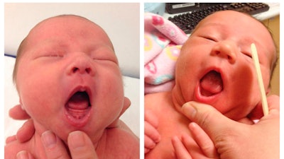 This combination of photos provided by Dr. Maya Bunik in July 2024, shows a baby with ankyloglossia where the tongue does not extend beyond the gums, left, and a baby with an indentation at the tip of a the tongue which may be a sign of ankyloglossia. On Monday, July 29, 2024, one of the largest doctor's groups in the U.S., voiced concerns that the condition, also known as 'tongue-tie' which can affect breastfeeding, is being over-diagnosed and often treated with unnecessary surgery to babies' mouths.