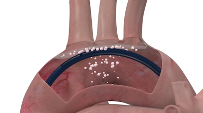 Prot Embo In Aorta