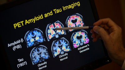 A doctor points to PET scan results that are part of a study on Alzheimer's disease at Georgetown University Hospital, on Tuesday, May 19, 2015, in Washington.