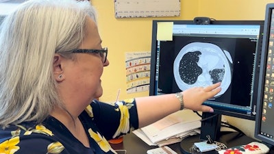 Dr. Lee Morissette shows an image of lungs damaged by asbestos exposure, April 4, 2024, at the Center for Asbestos Related Disease in Libby, Mont.