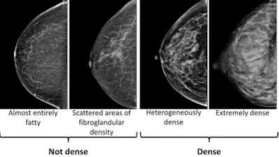 This image provided by the UW/Fred Hutch Cancer Center Breast Imaging in October 2024 shows mammogram scans with dense and not dense tissue.