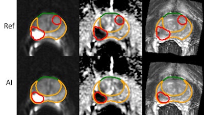 Imaging of prostate cancer comparatively to AI.