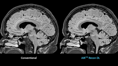 A comparison between conventional imaging versus GE's Air Recon DL imaging.