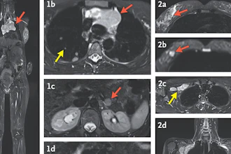 These MRI images with arrows indicating cancer were made during a study by researchers at the National Institutes of Health and published Wednesday, Dec. 4, 2024, in the New England Journal of Medicine.