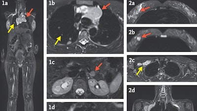 These MRI images with arrows indicating cancer were made during a study by researchers at the National Institutes of Health and published Wednesday, Dec. 4, 2024, in the New England Journal of Medicine.