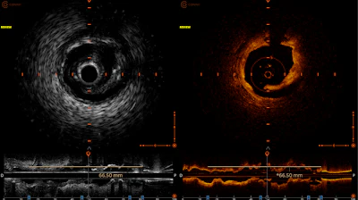Example Of Side By Side Hybrid Ivus Oct Image