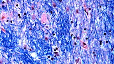 This microscope photo provided by the McLean Hospital's Harvard Brain Tissue Resource Center in January 2024 shows cells in the caudate nucleus structure of the brain in a person with Huntington's disease.