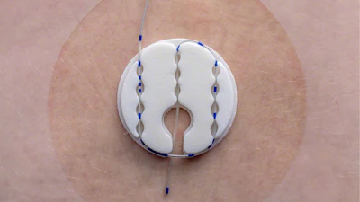 Clik Fix Epidural Pnbcathetersecuremnt