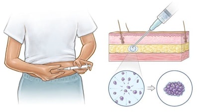 A graphical abstract illustrating the non-surgical contraceptive implant delivered through tiny needles.