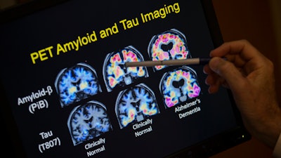 R. Scott Turner, Professor of Neurology and Director of the Memory Disorder Center at Georgetown University Hospital, points to PET scan results that are part of a study on Alzheimer's disease at Georgetown University Hospital in Washington, May 19, 2015.